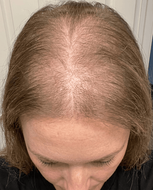 Your Follicles Already Asleep